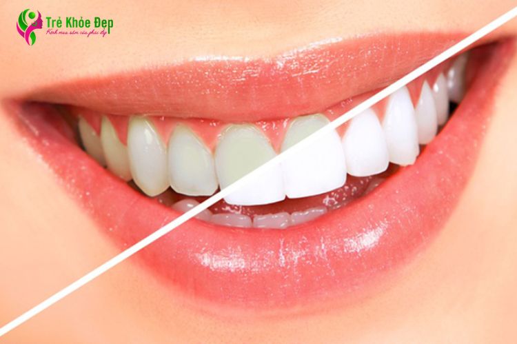  Cách làm trắng răng tại nhà đơn giản, hiệu quả nhanh chóng
