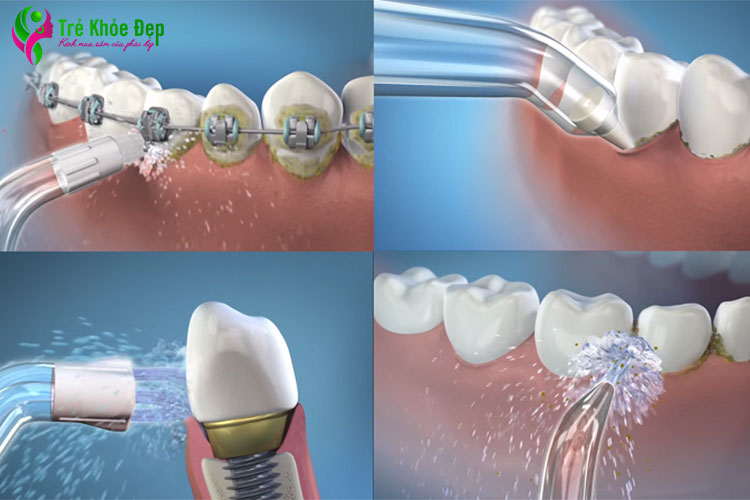 Máy tăm nước giúp loại bỏ mảnh vụn giữa các kẽ răng