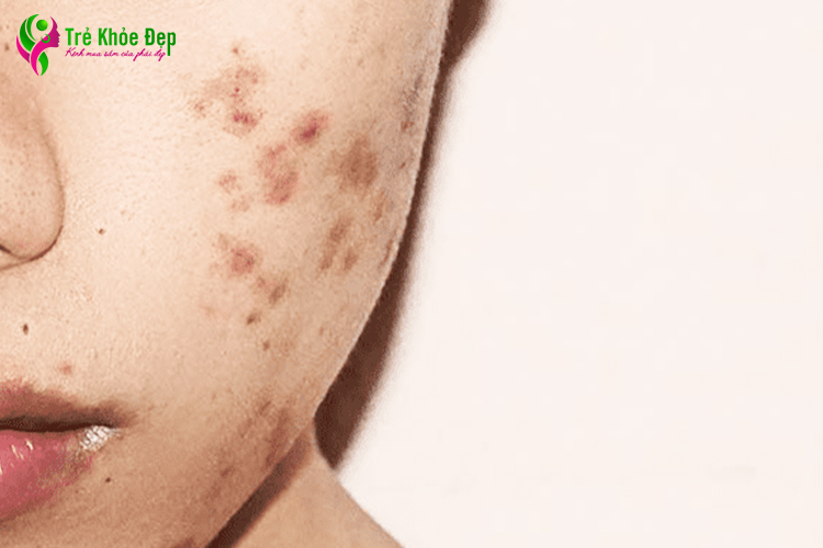 Thâm mụn là hiện tượng có vệt tối màu tại các vùng da đã bị tổn thương do mụn gây ra