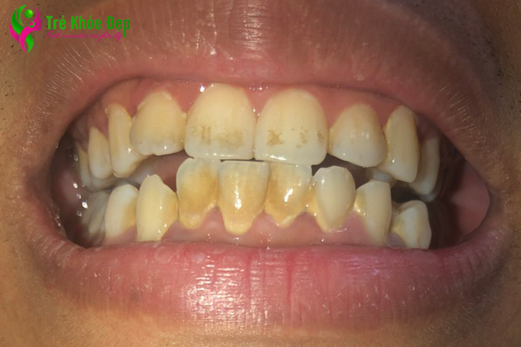 Men răng có thể ảnh hưởng đến tình trạng ố vàng răng