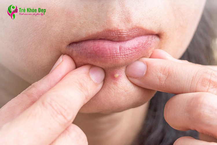 Mụn đầu đinh thường mọc quanh miệng có ngòi mủ, gây ngứa da và cực kỳ khó chịu