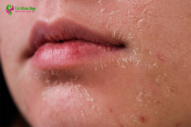 Khi dị ứng mỹ phẩm, da có thể sẽ khô và bong tróc mảng da