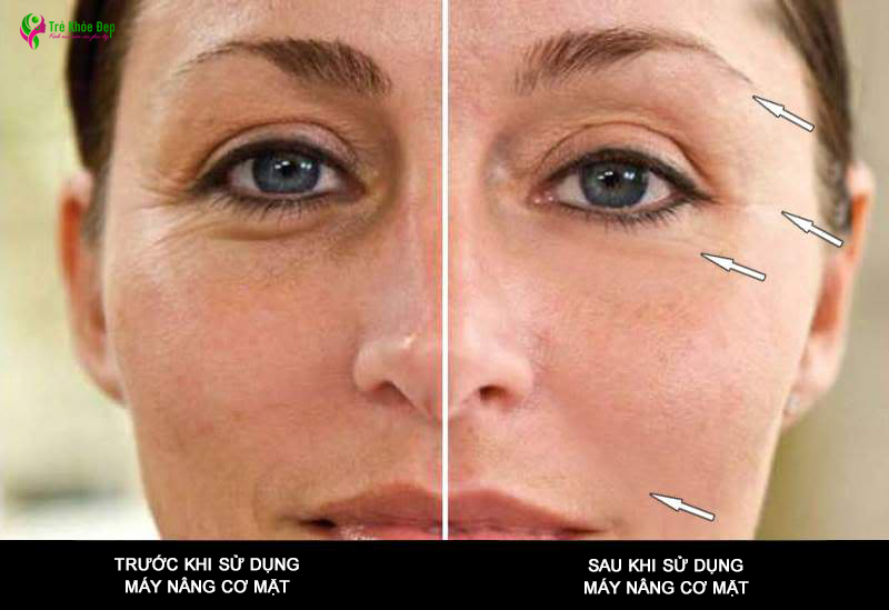 Làn da trước và sau khi sử dụng máy nâng cơ mặt