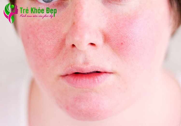 Da khô luôn trong tình trạng ửng đỏ và đau rát, bạn nên thường xuyên cấp ẩm cho da