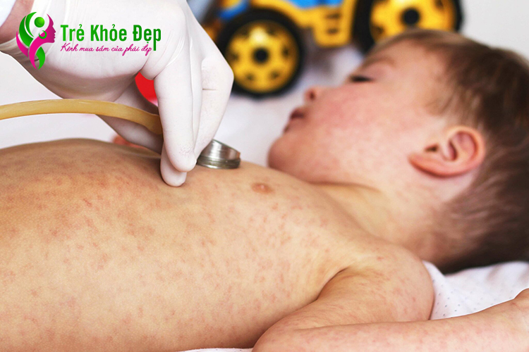 Các triệu chứng của bệnh sốt phát ban ở trẻ em