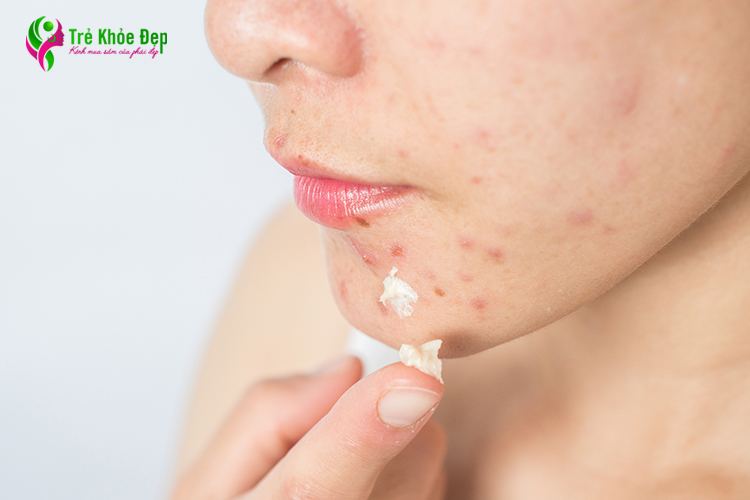 5 Tác hại của việc bôi kem đánh răng lên mặt bạn nên biết